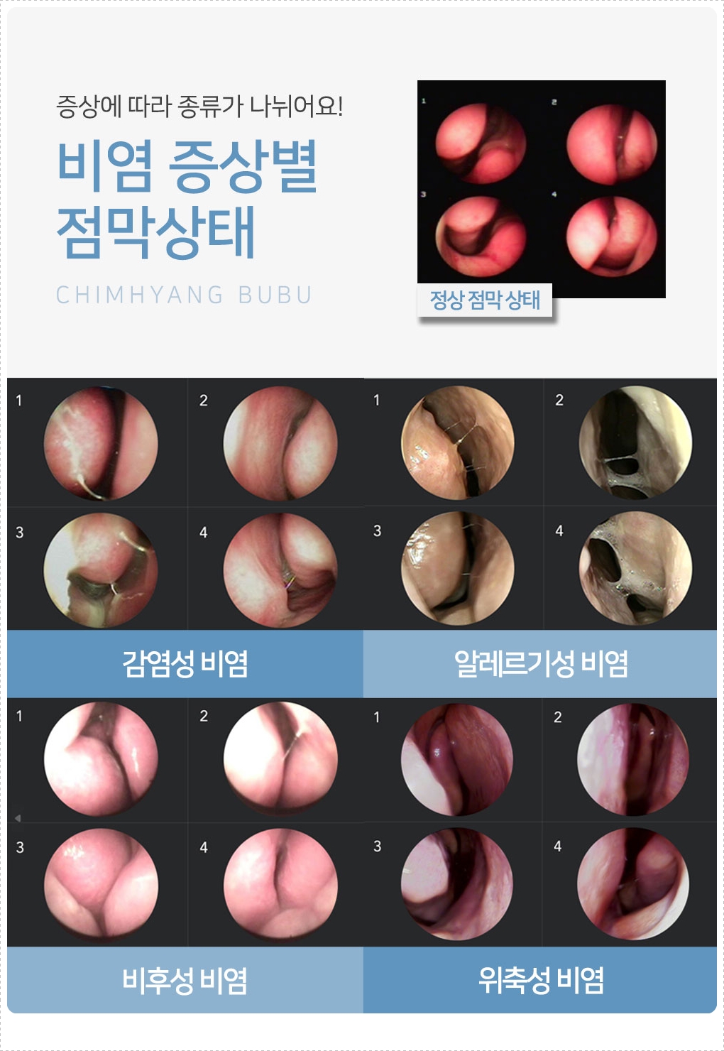 알레르기 비염과 만성 비염의 차이점을 설명하는 동탄비염 한의원 건강 가이드