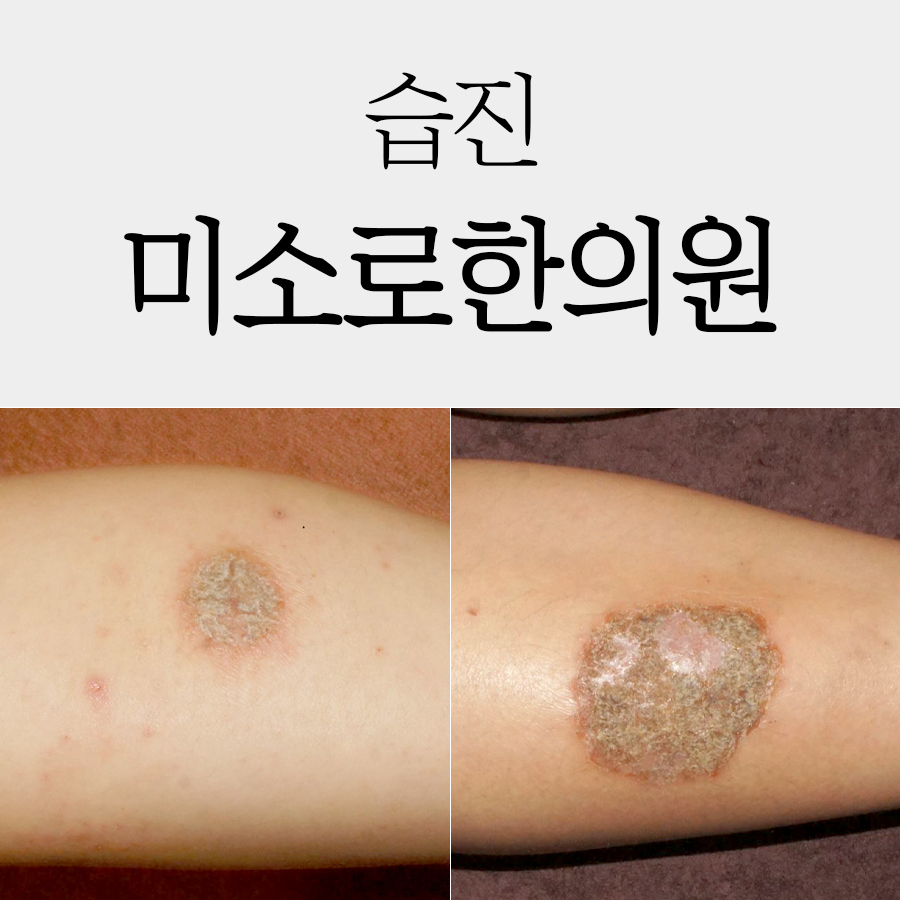 메디가이드 - B타입 습진 2