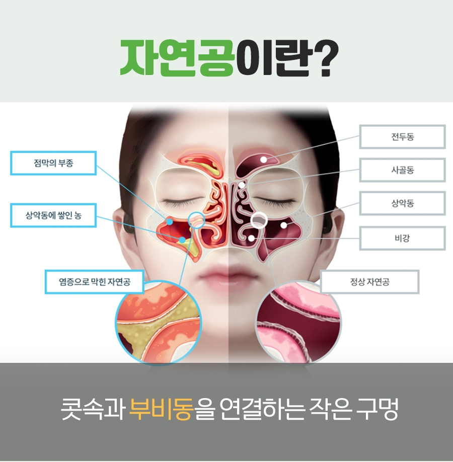 분당축농증한의원 코막힘과 콧물 증상을 살펴보는 방법 8 경기광주축농증한의원007