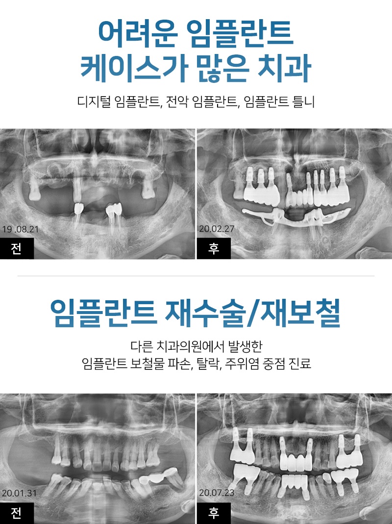 덕풍동임플란트9 1