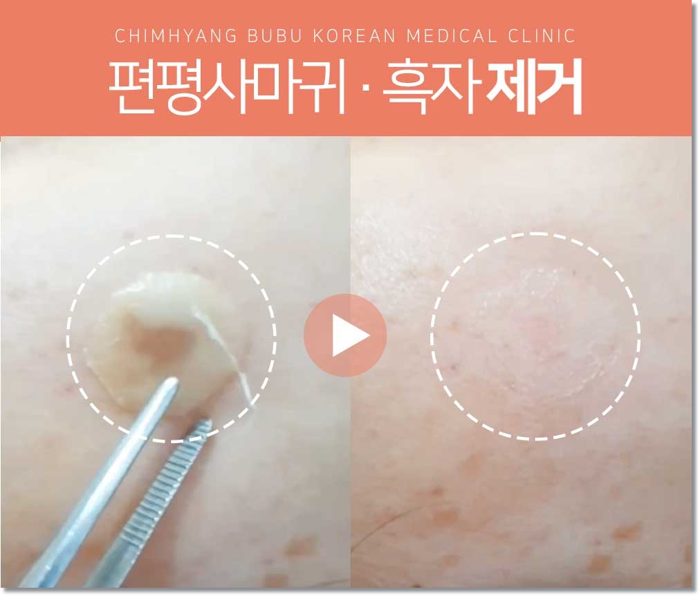 동탄 흑자 피부과04