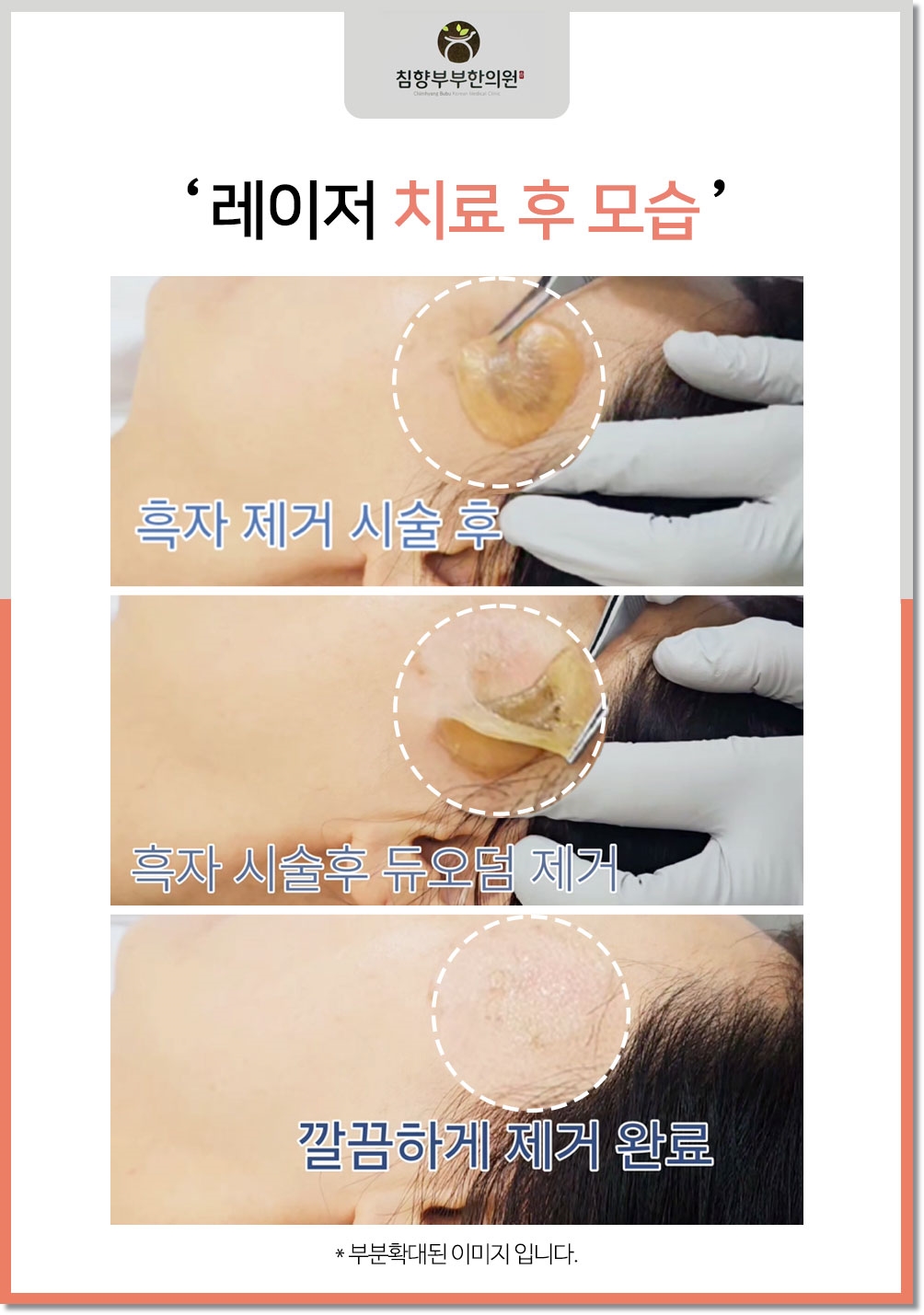 동탄 흑자 피부과13