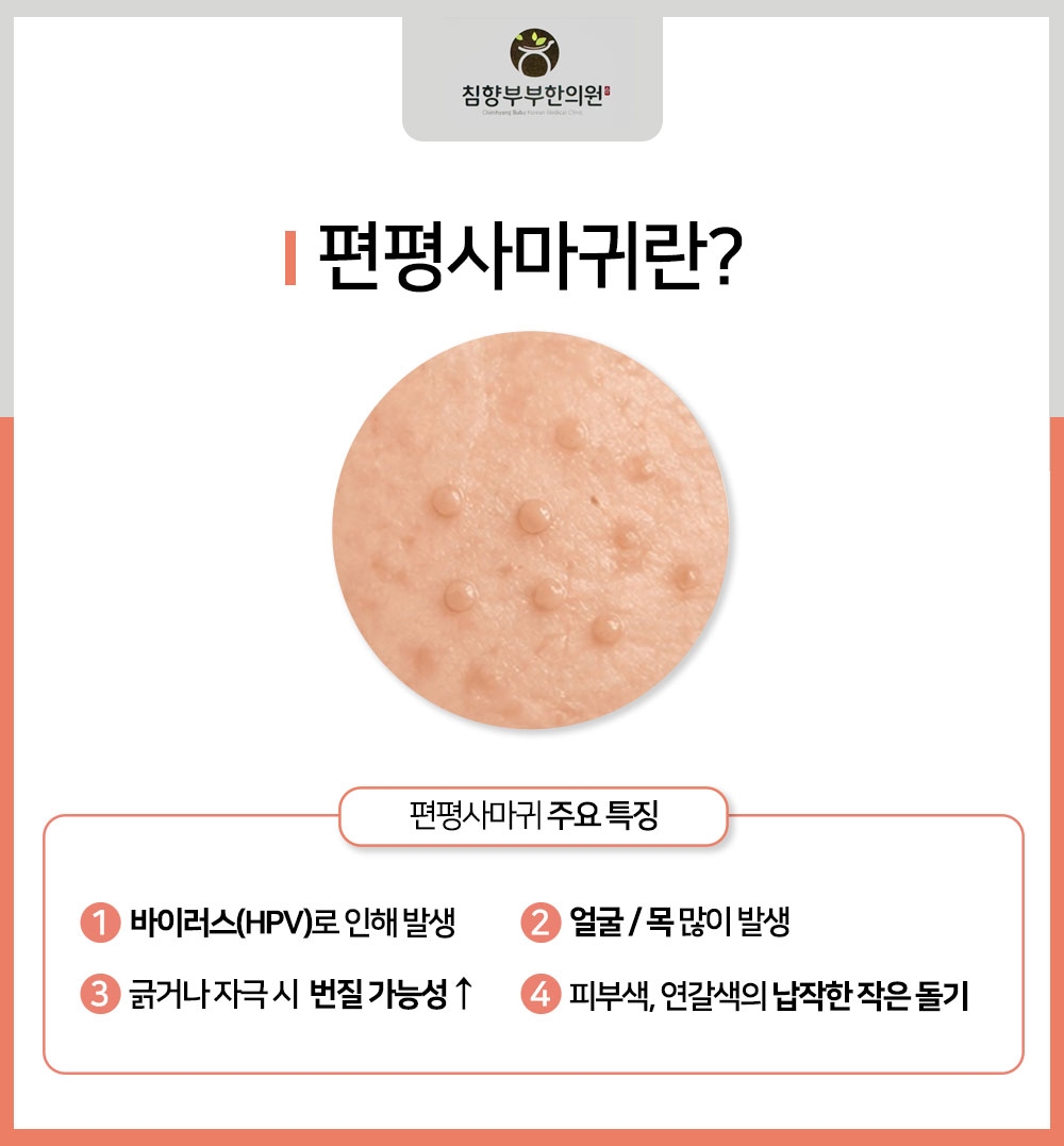 동탄편평사마귀레이저06