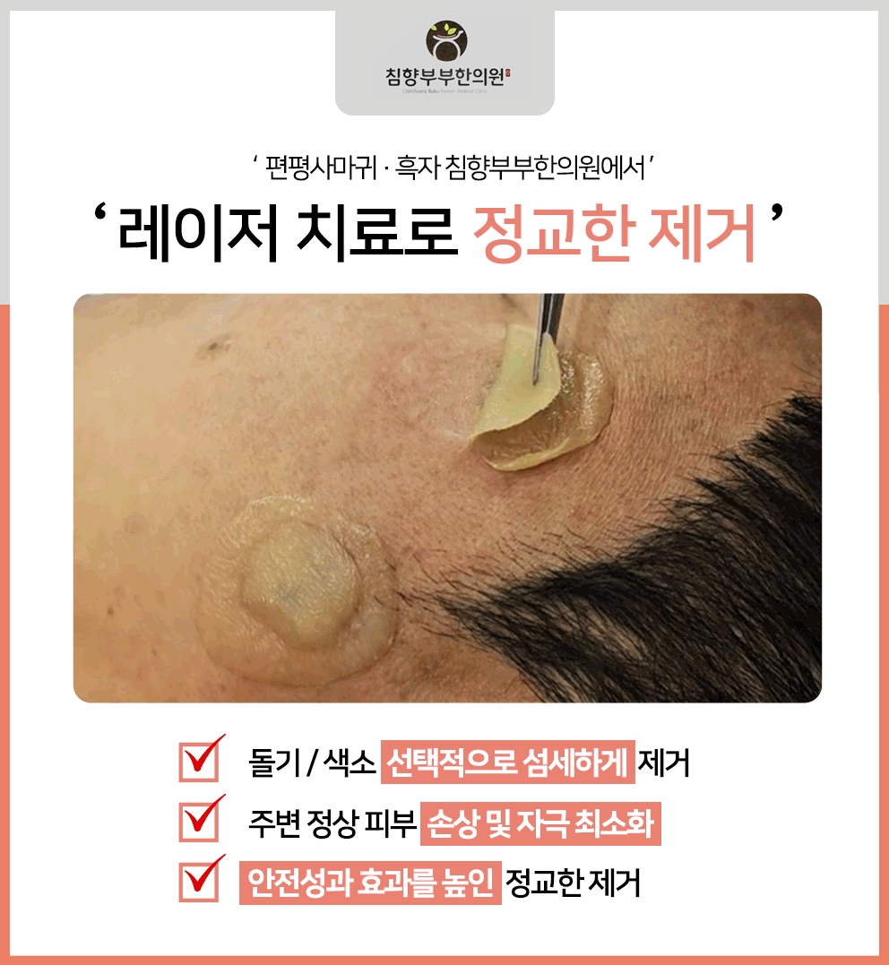 동탄편평사마귀레이저09