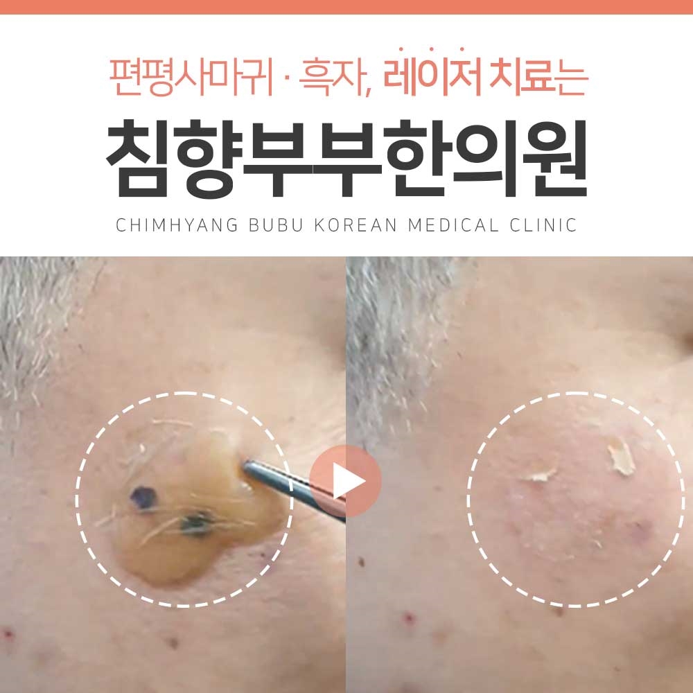 메디가이드 - 동탄흑자없애는방법01