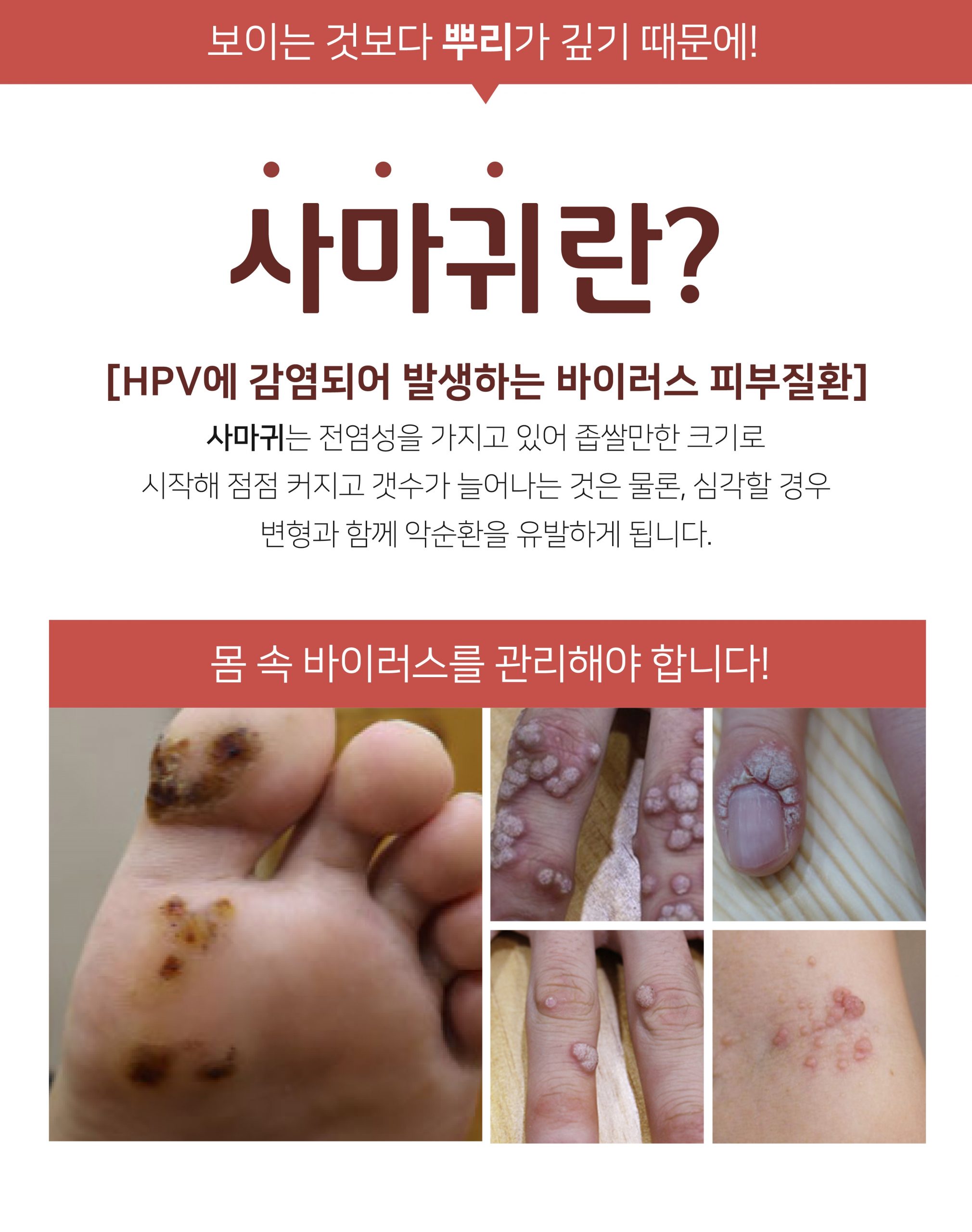 발가락 분당 사마귀 제거 피부과02 scaled