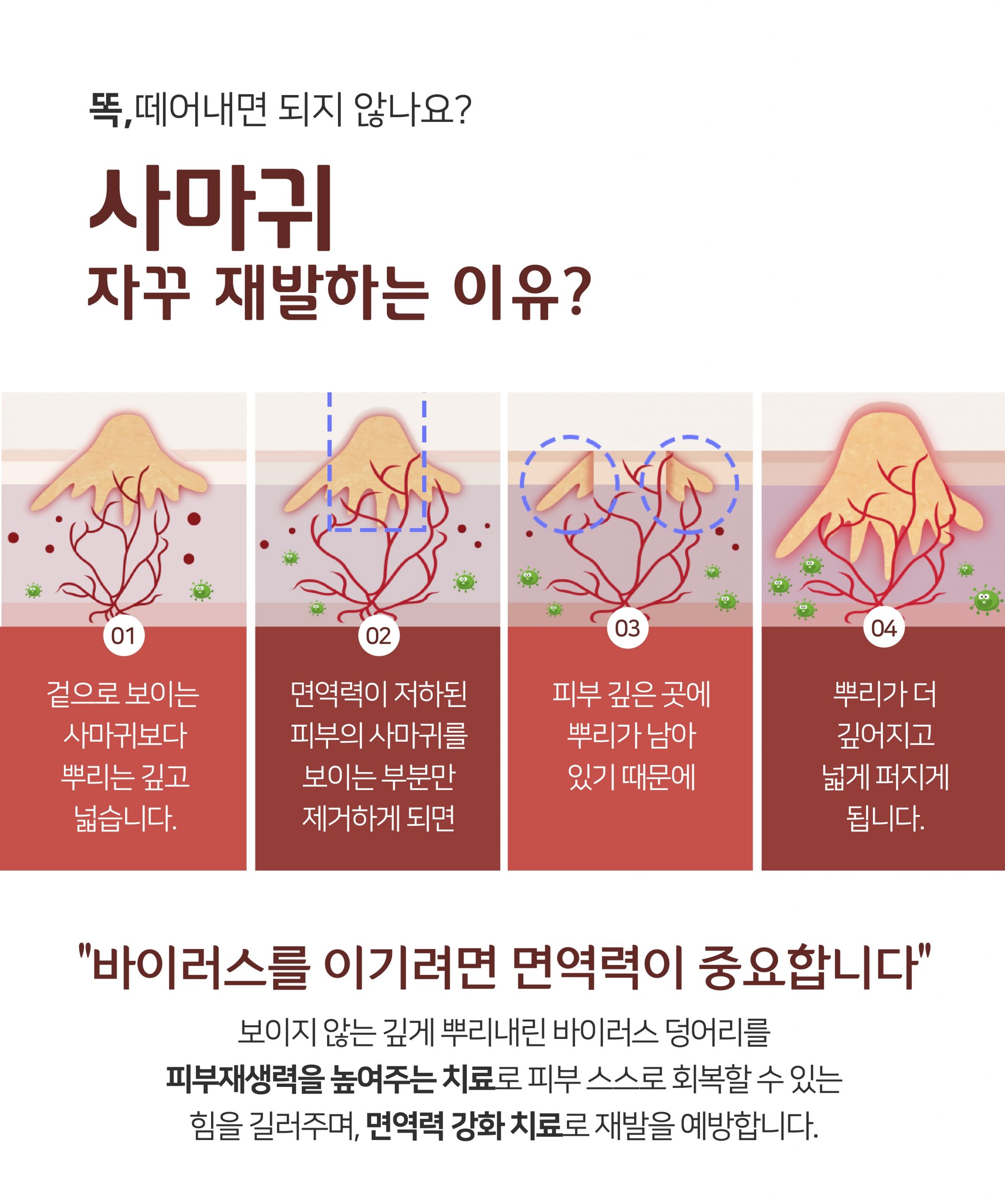 발가락 분당 사마귀 제거 피부과03 scaled