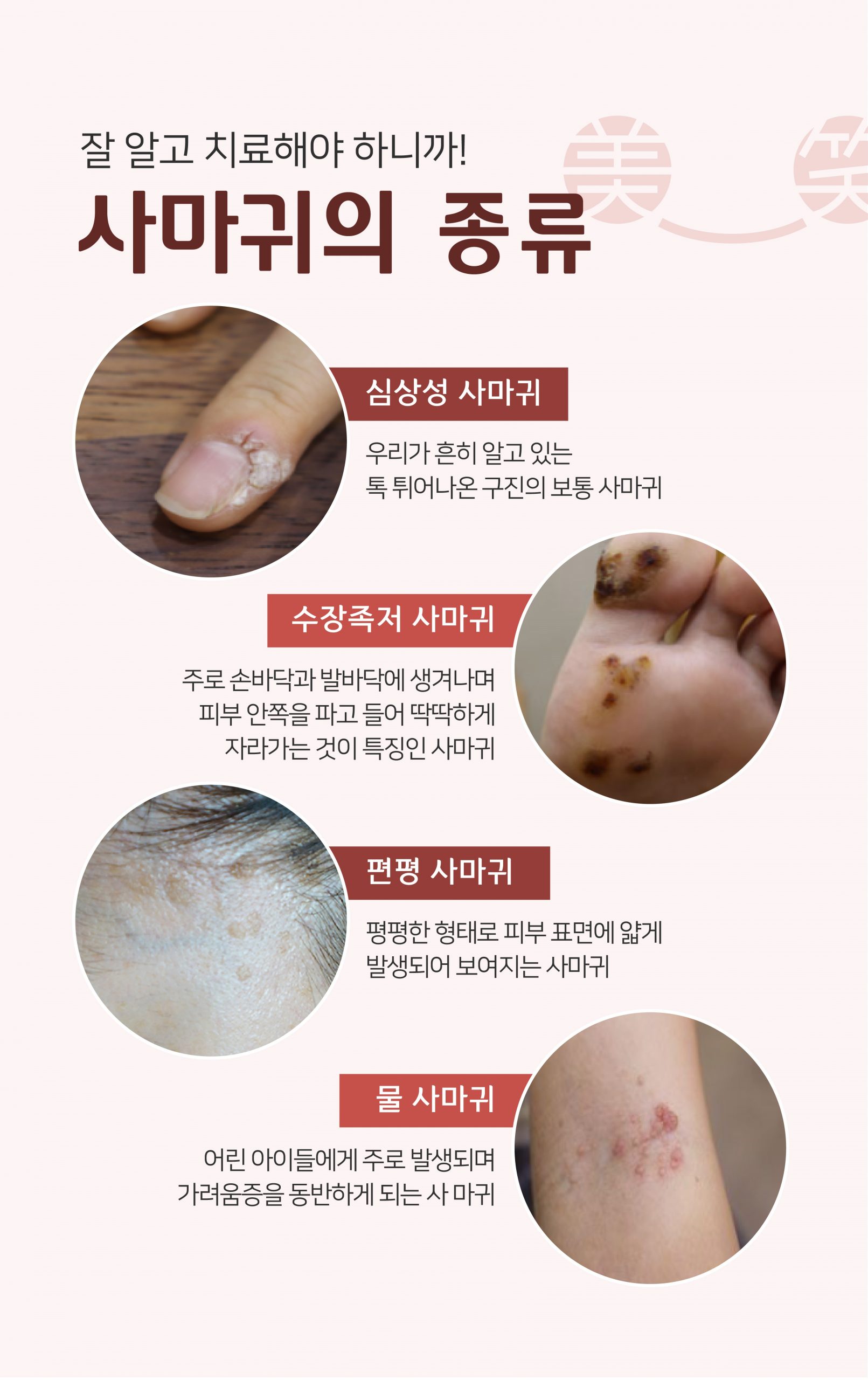 발가락 분당 사마귀 제거 피부과04 scaled