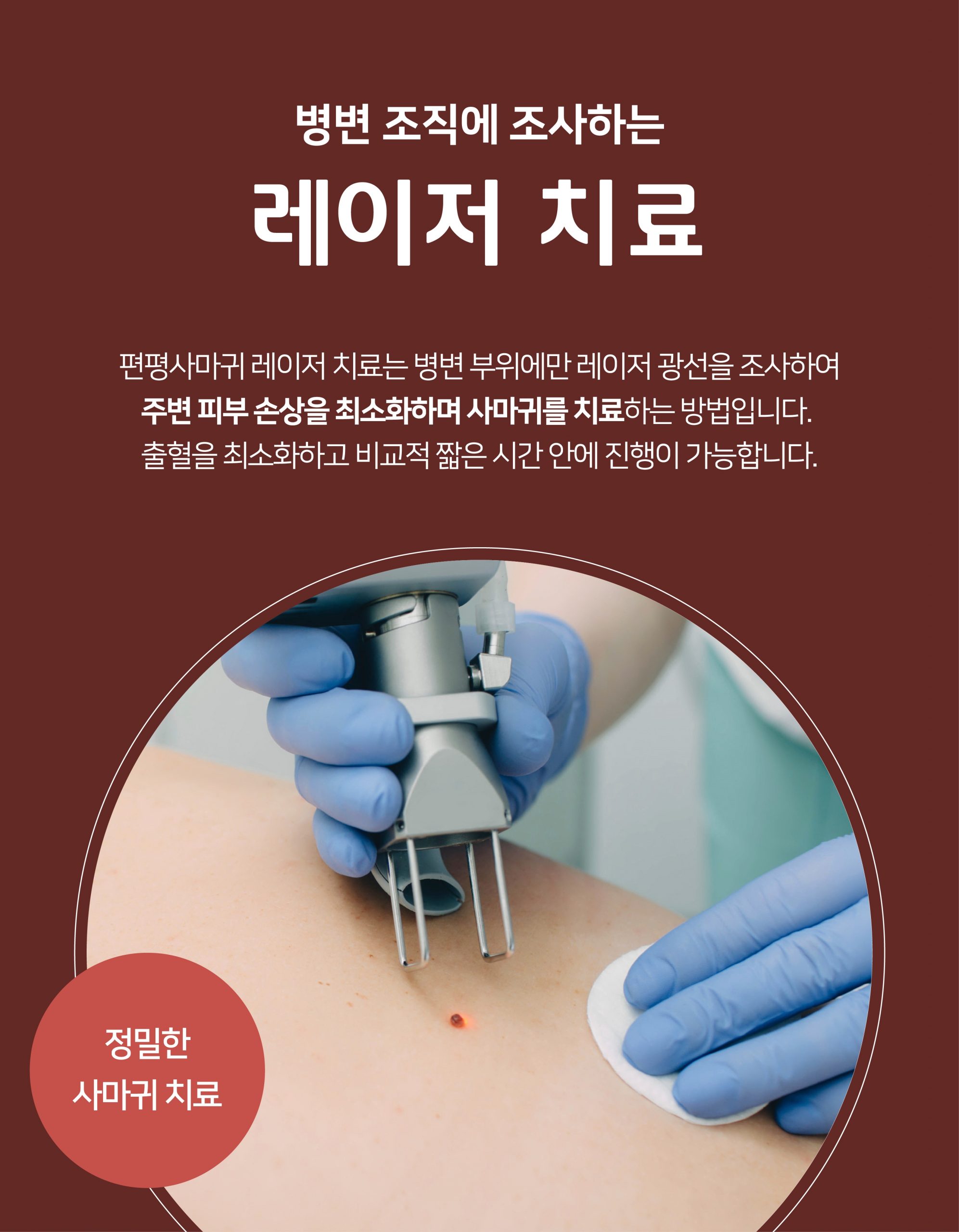 발가락 분당 사마귀 제거 피부과09 scaled