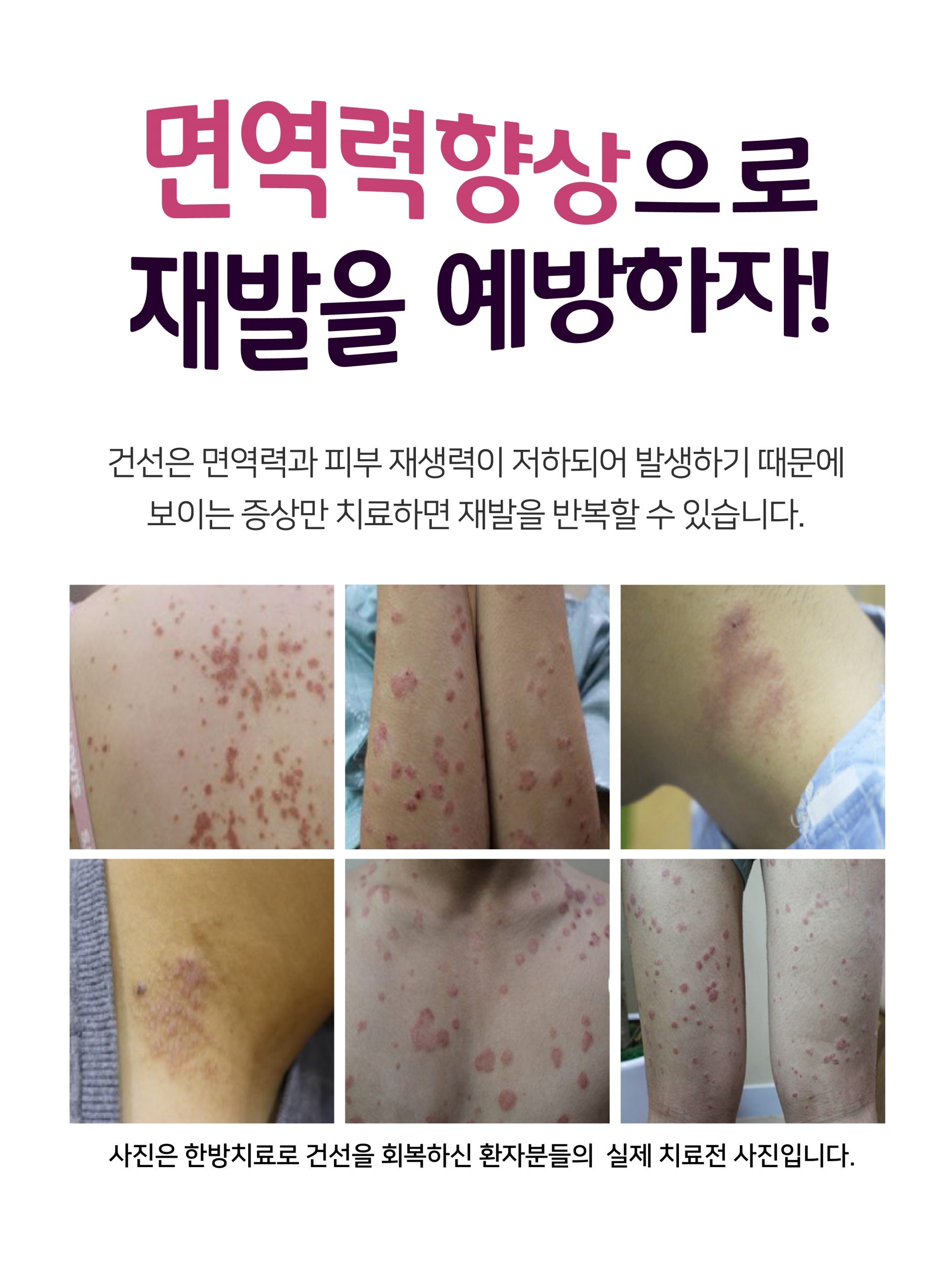 분당피부건선치료법04 scaled