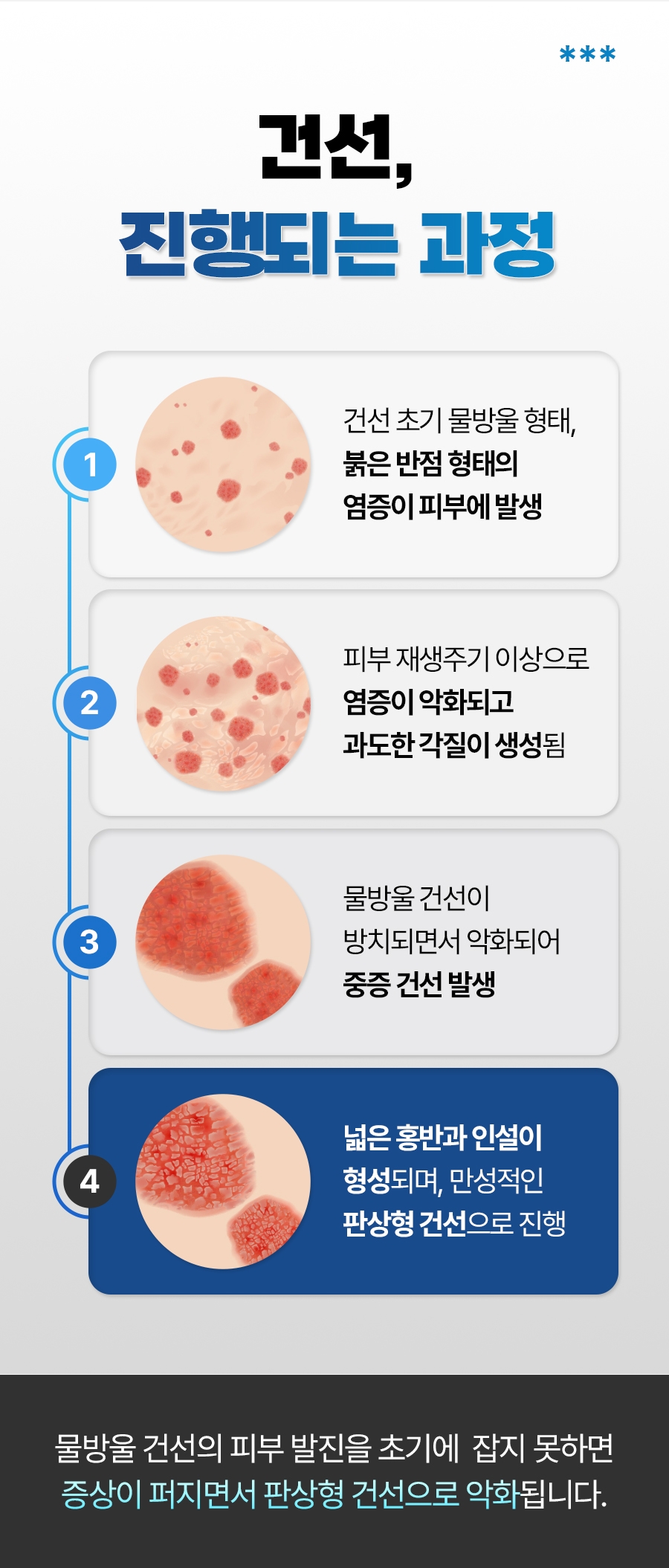 성남 건선 치료07