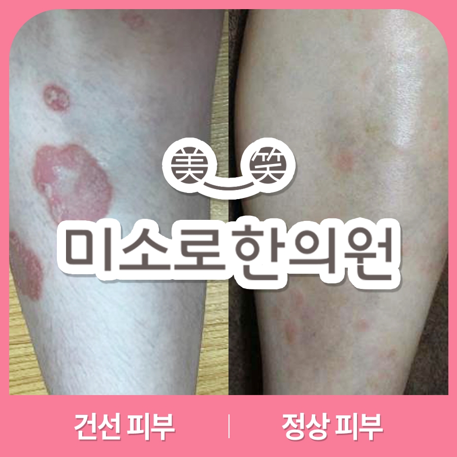 메디가이드 - 성남 건선 치료14