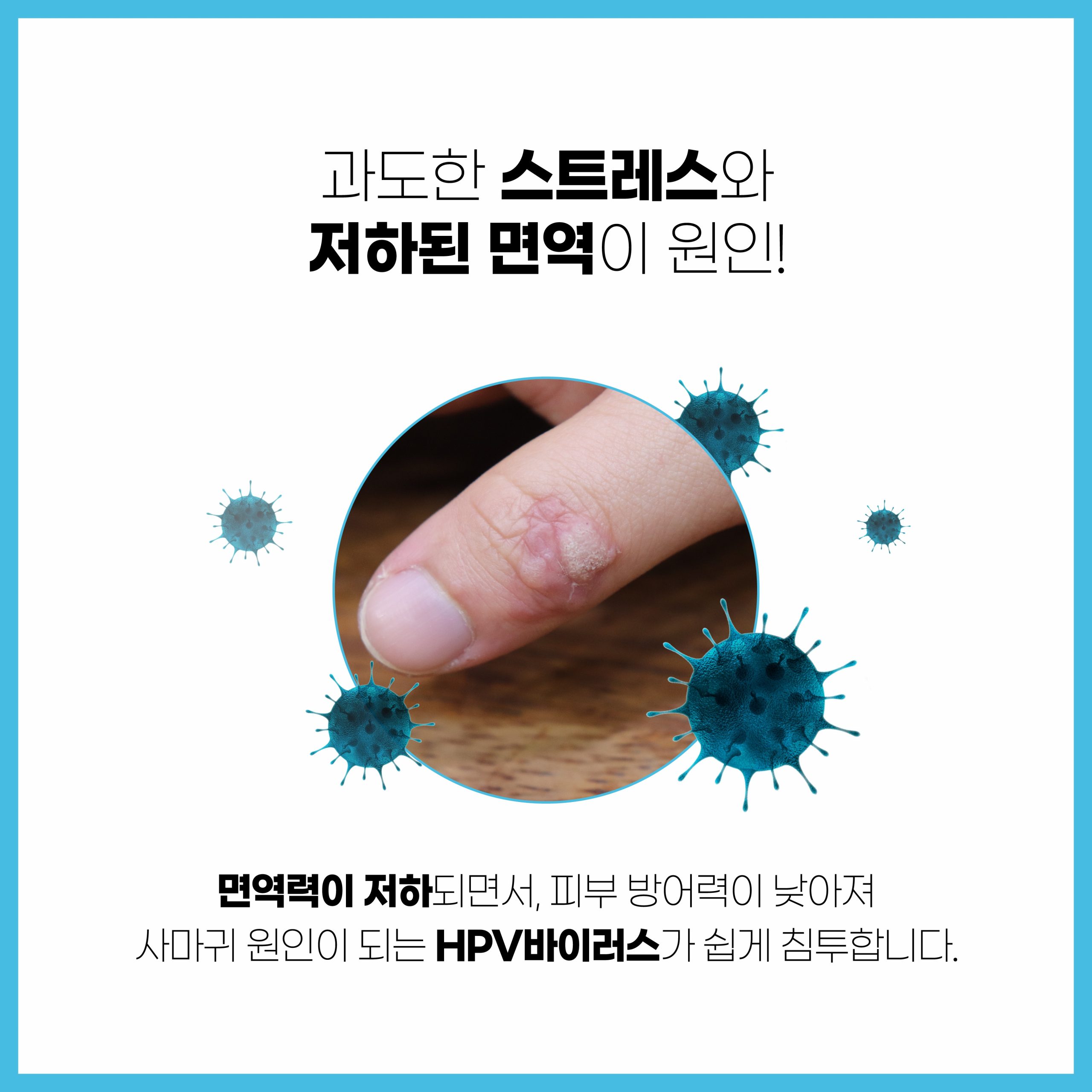 성남 사마귀 제거03 scaled