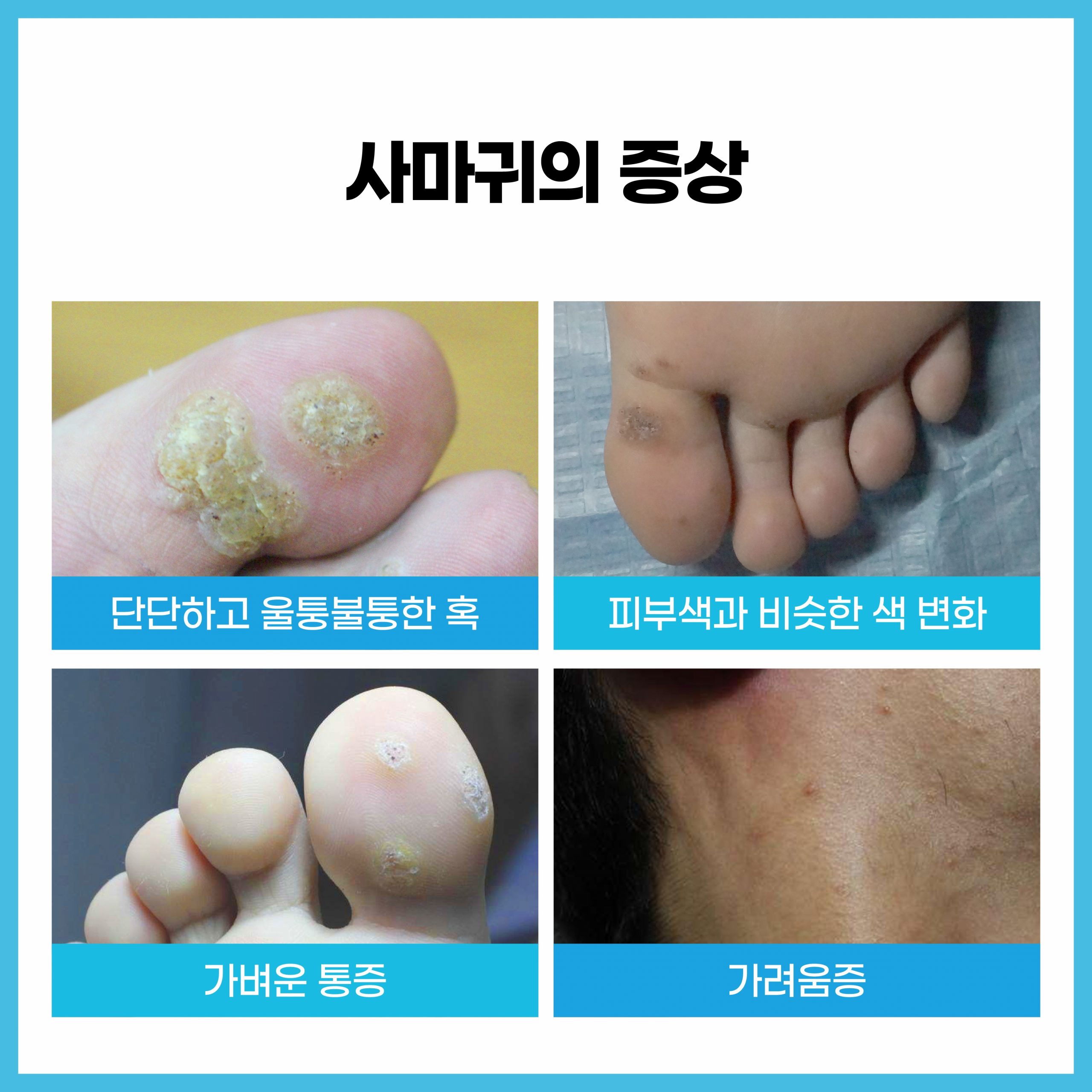 성남 사마귀 제거04 scaled