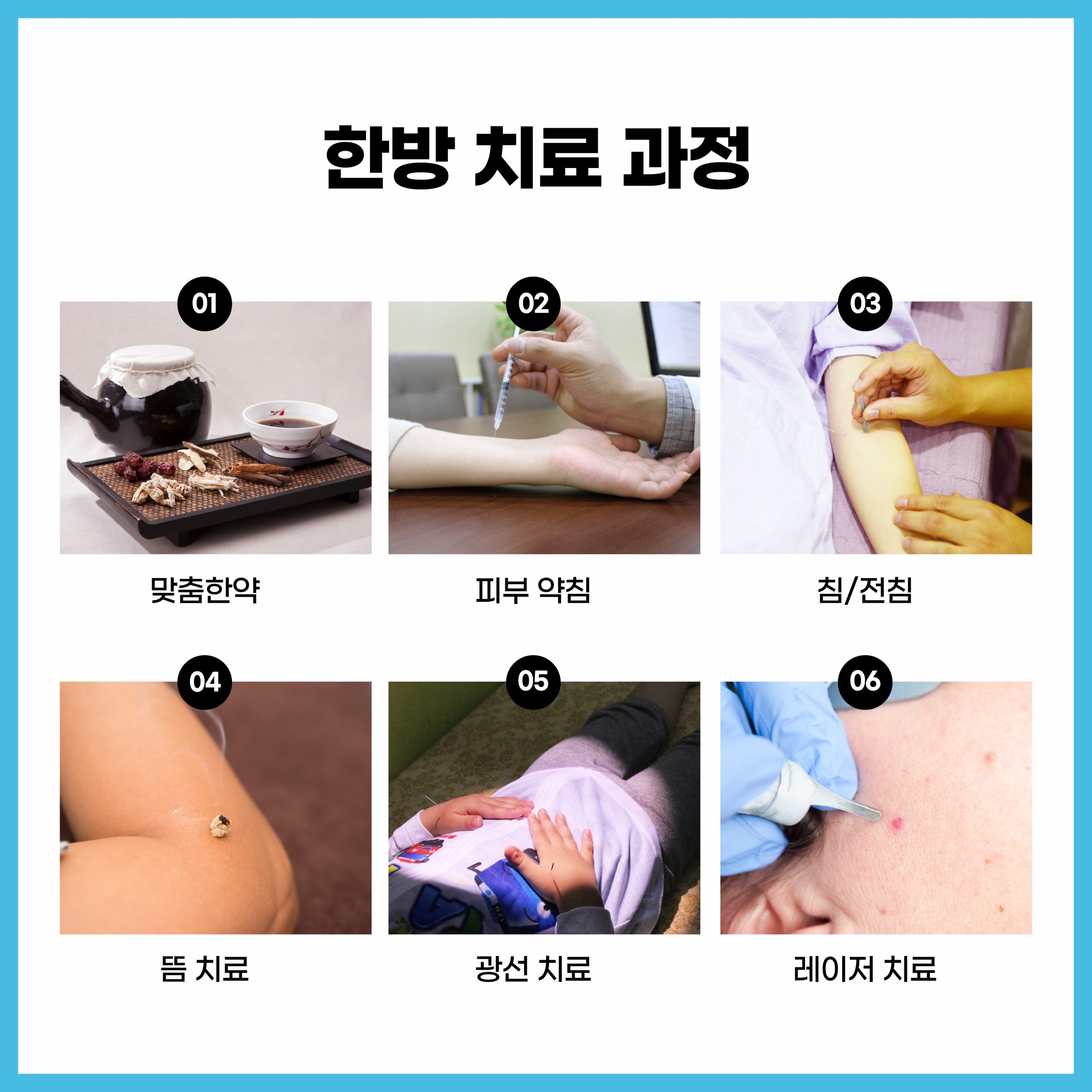 성남 사마귀 제거06 scaled