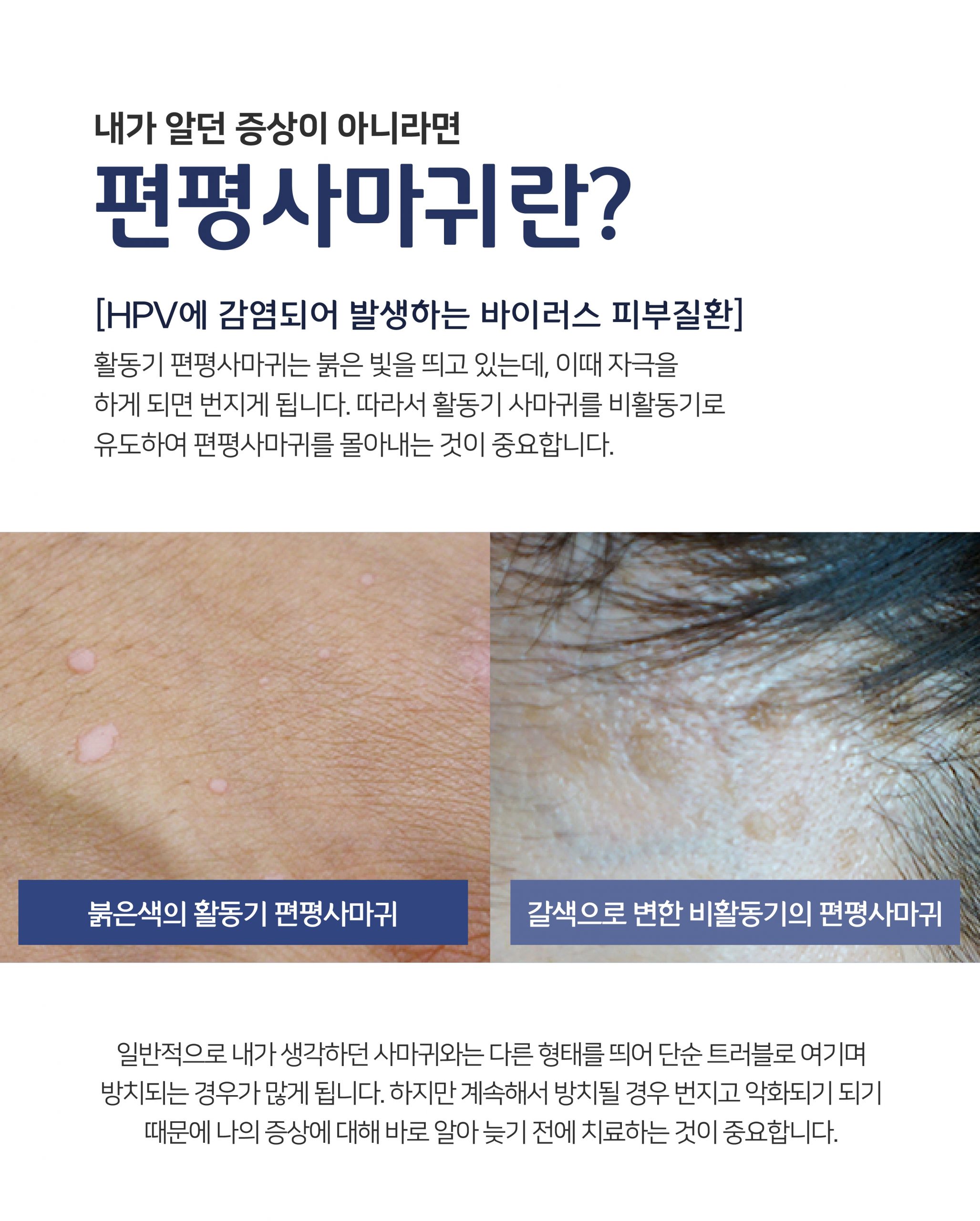 여주 편평사마귀 제거003 scaled