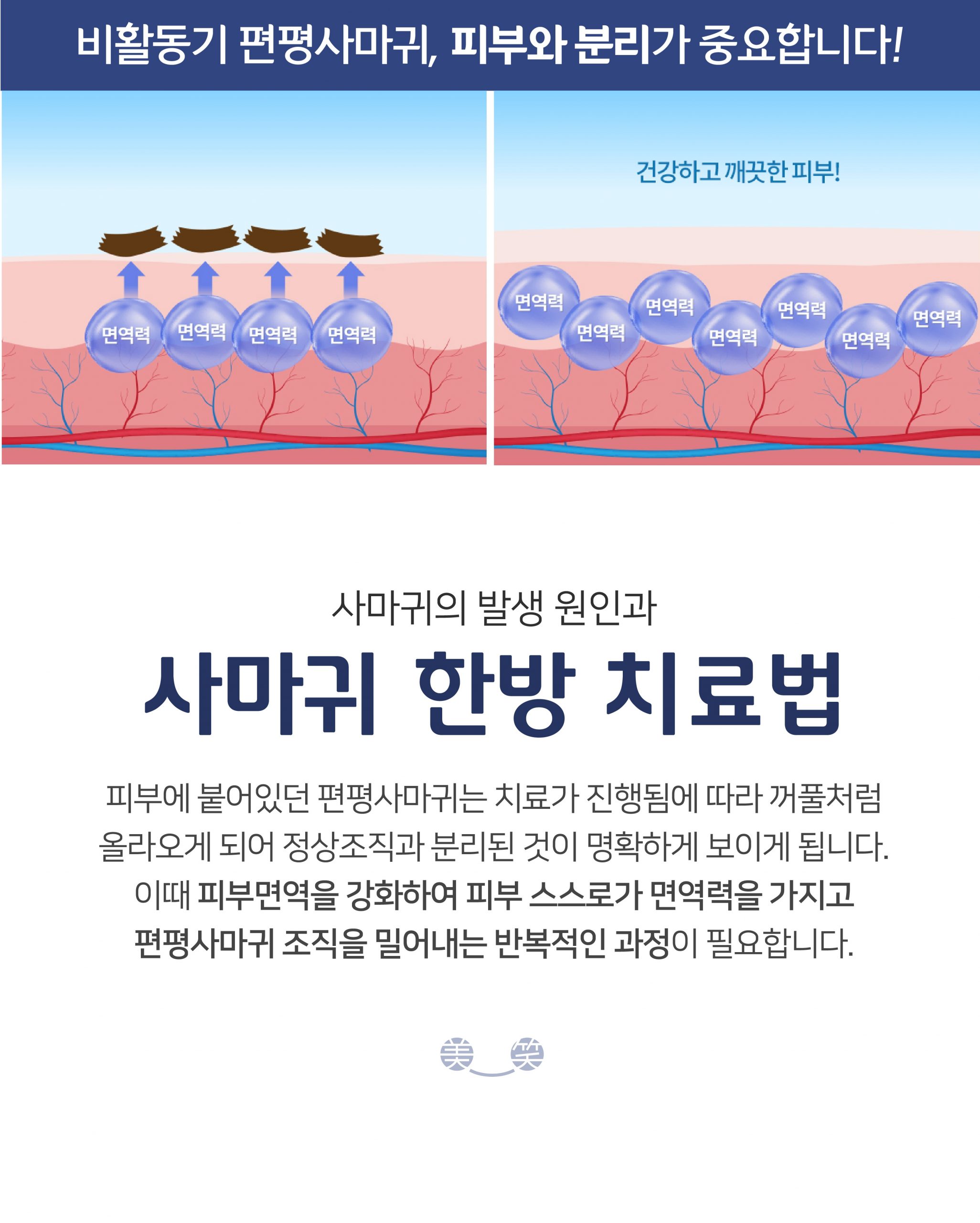 여주 편평사마귀 제거005 scaled