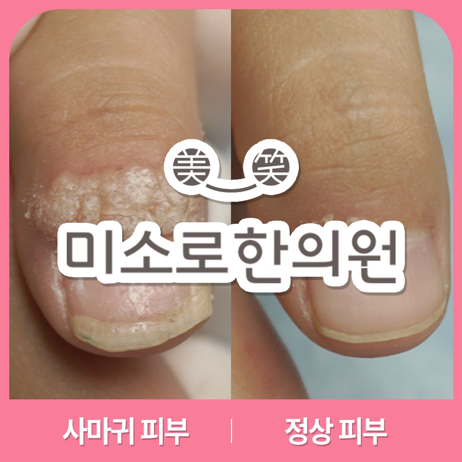 메디가이드 - 여주 편평사마귀 제거013