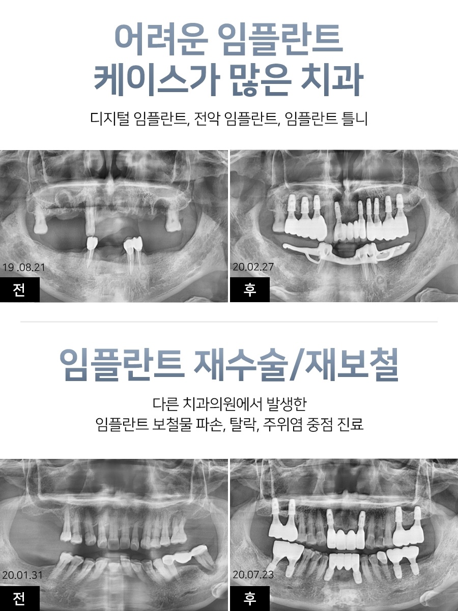 역북임플란트8
