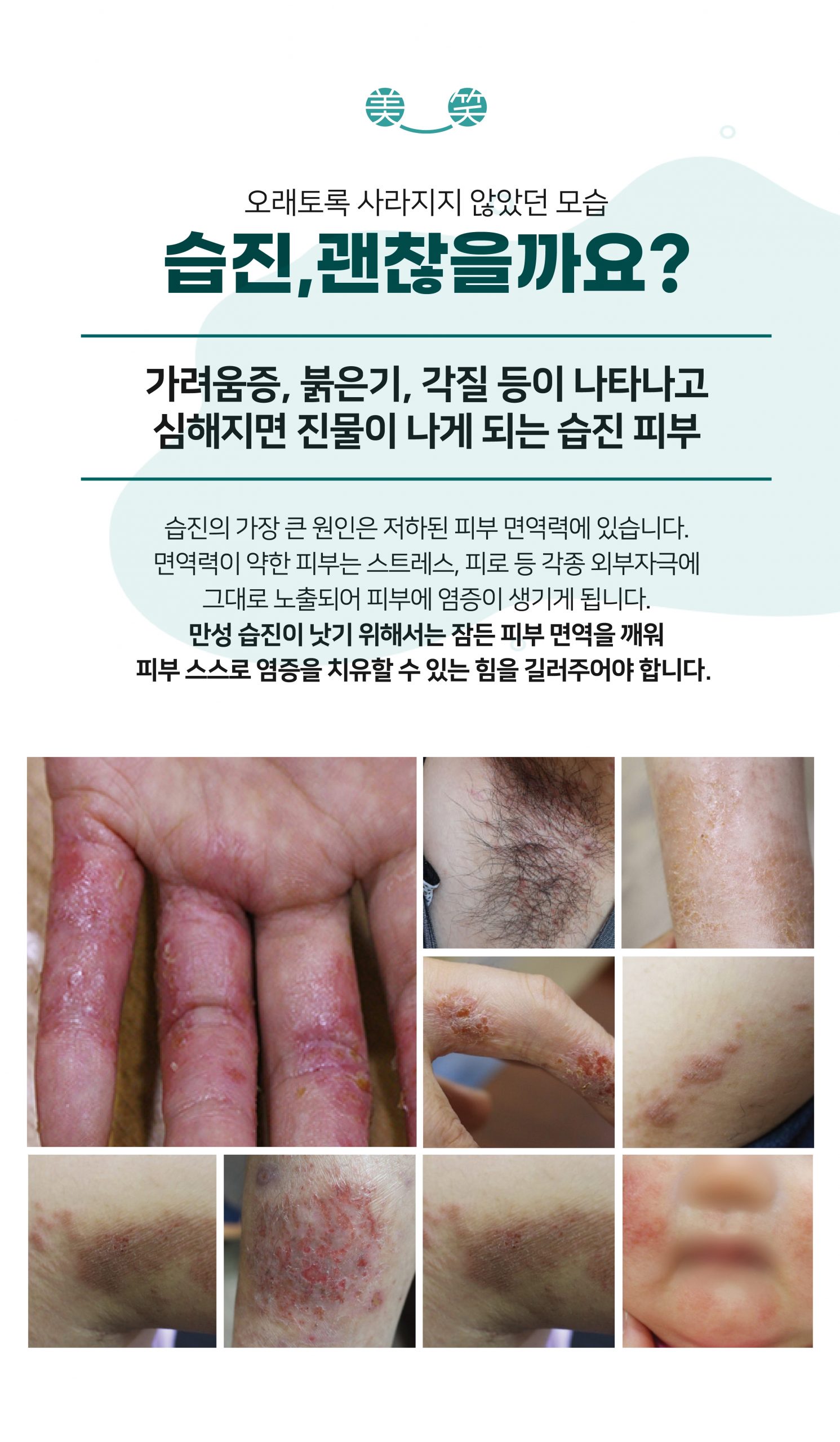 위례화폐상습진한의원004 scaled
