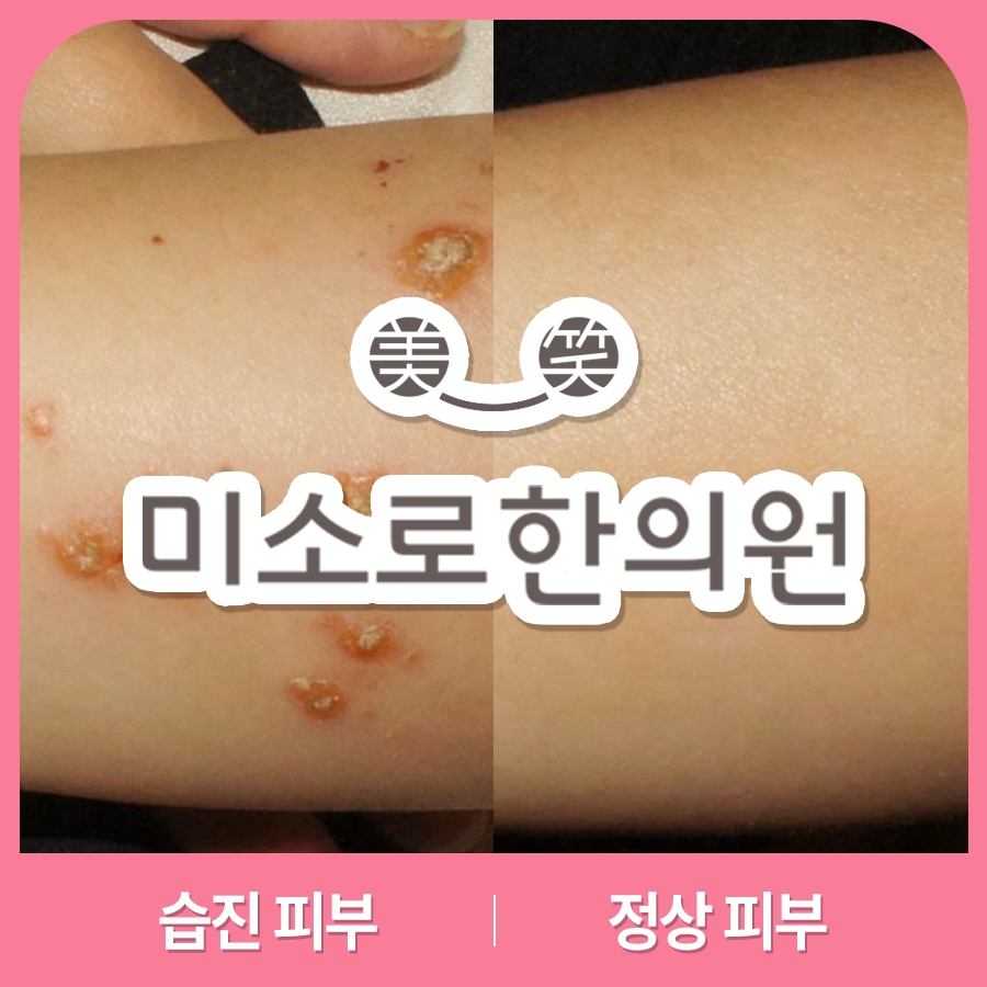 메디가이드 - 이천 습진 한의원014