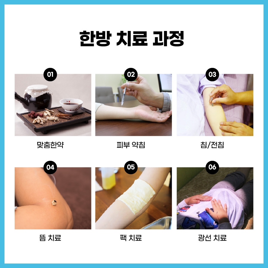 이천 안면홍조 치료008 1