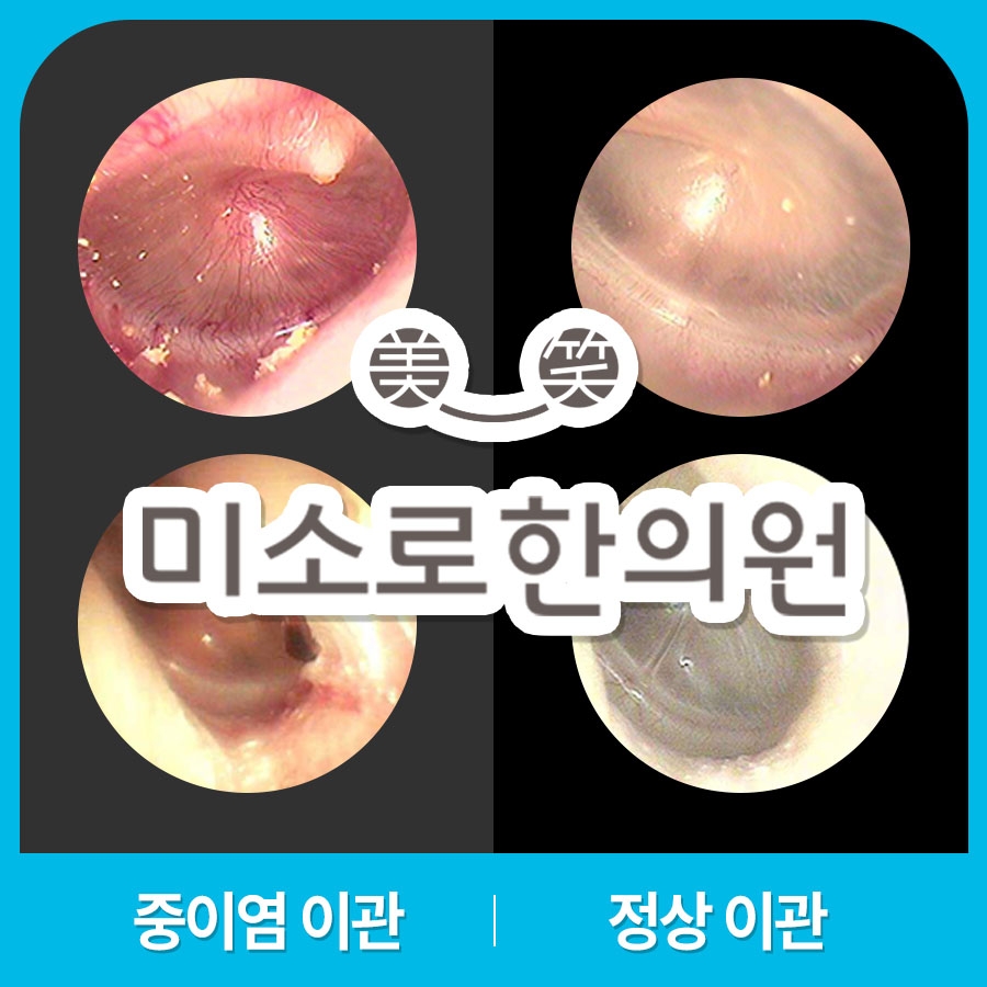 메디가이드 - 이천 중이염 치료013