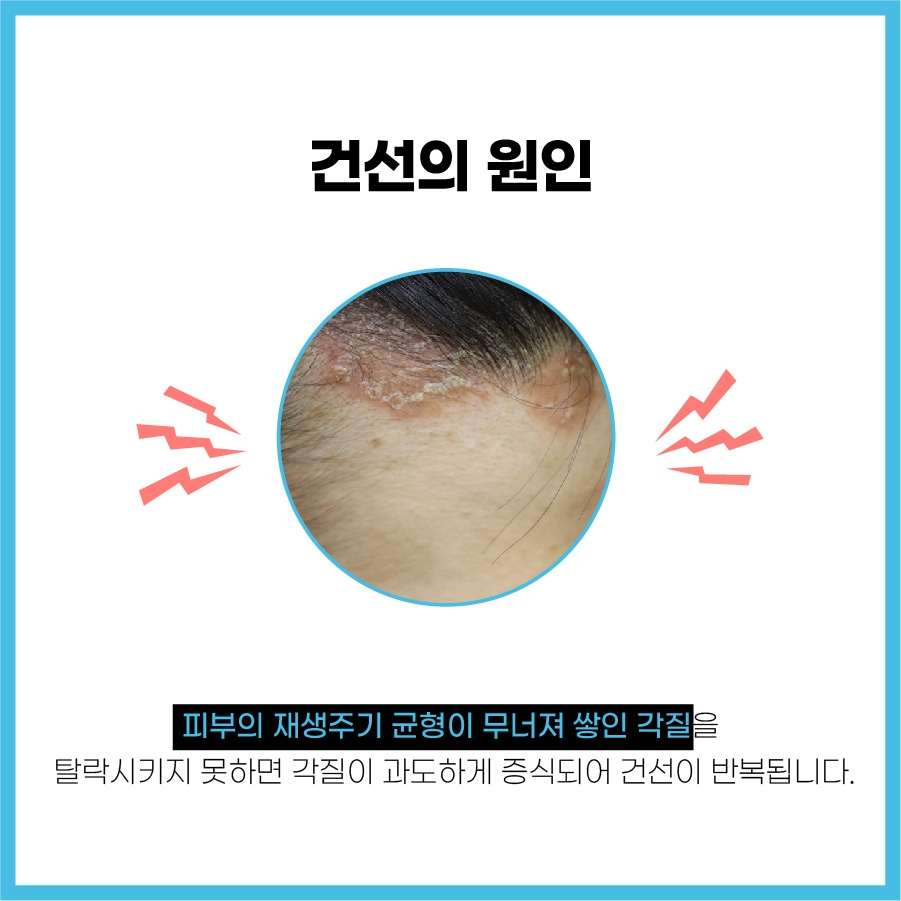 이천건선치료003