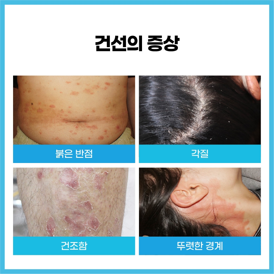 이천건선치료004