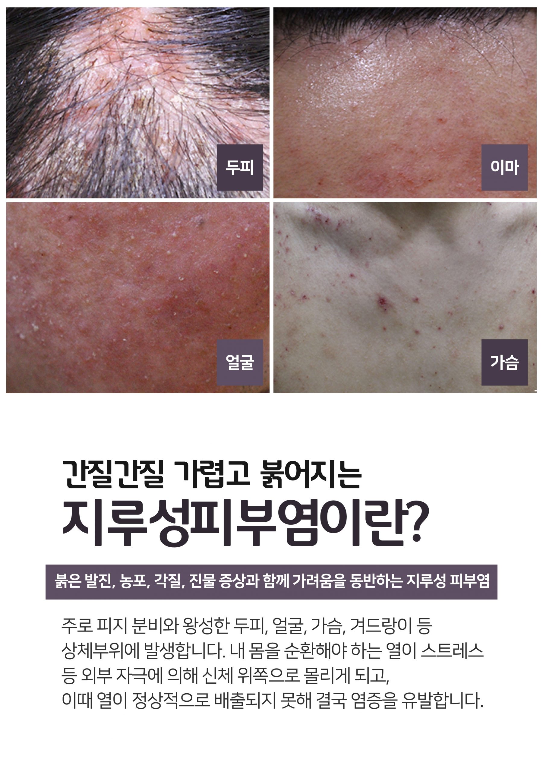 이천지루성피부염치료003 scaled