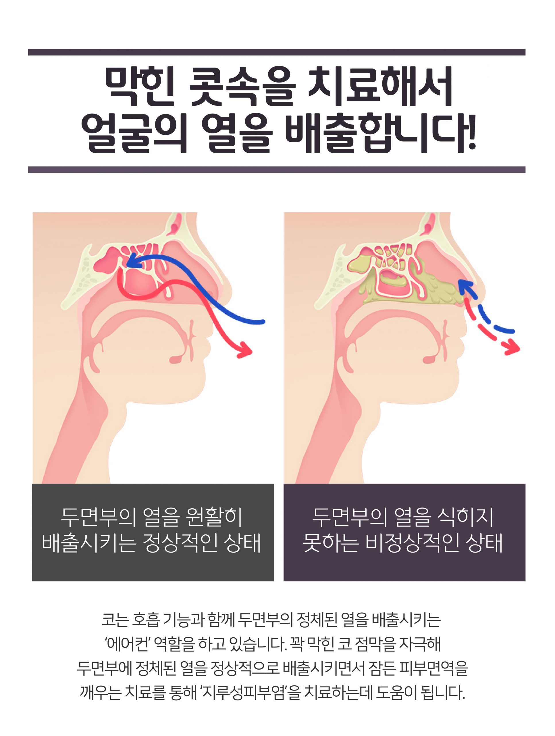 이천지루성피부염치료006 scaled