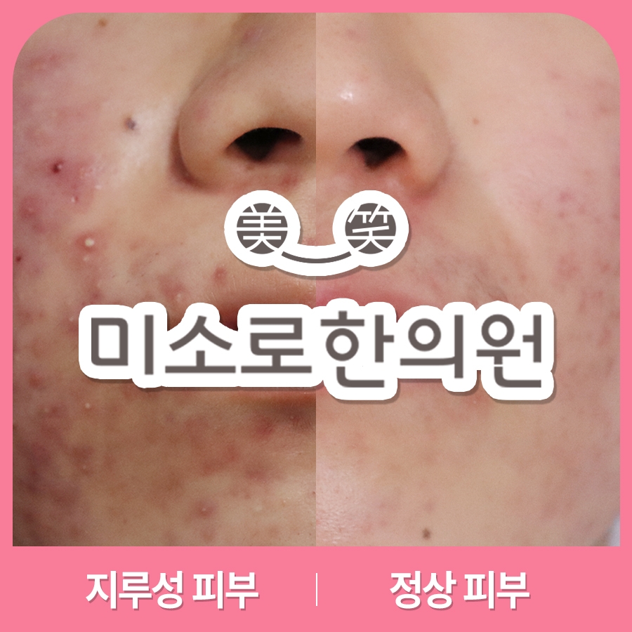 메디가이드 - 이천지루성피부염치료015
