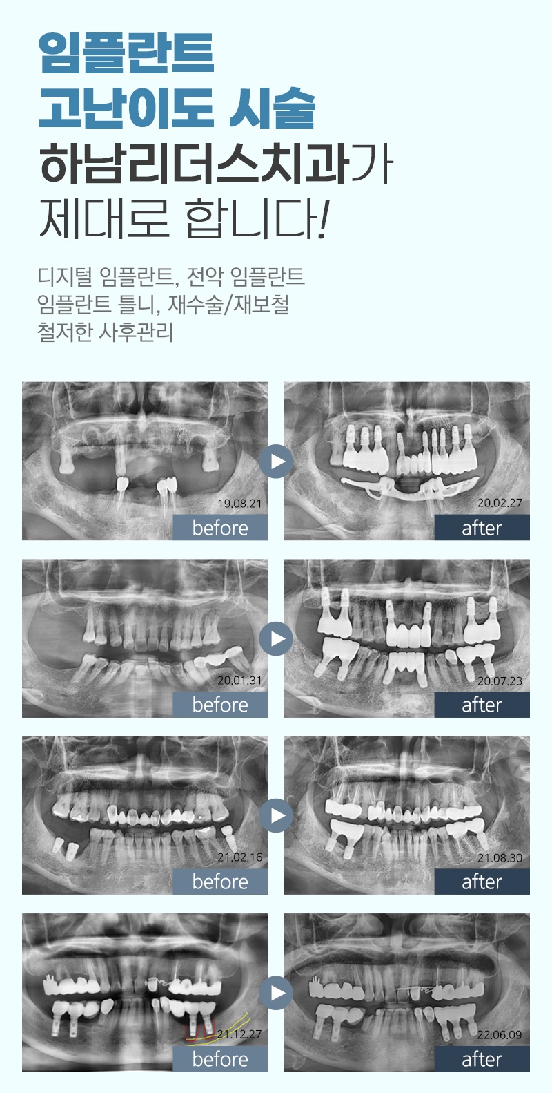 하남시청역임플란트추천7